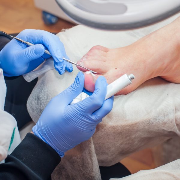 Podology treatment. Podiatrist treating toenail fungus. Doctor applying cream on removed ingrown nai
